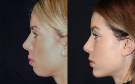 Best Aesthetic Clinic in dubai for Chin Fillers: How to Prepare Your Skin