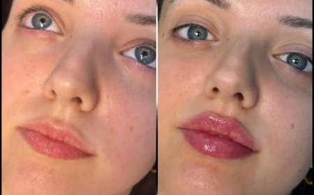 Best Aesthetic Clinic in dubai for Fillers: How to Manage Treatment Expectations