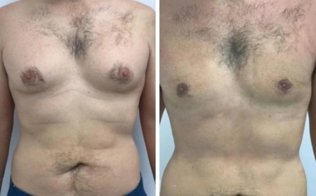 Gynecomastia in Dubai Cost: What You Need to Know Before Scheduling Surgery