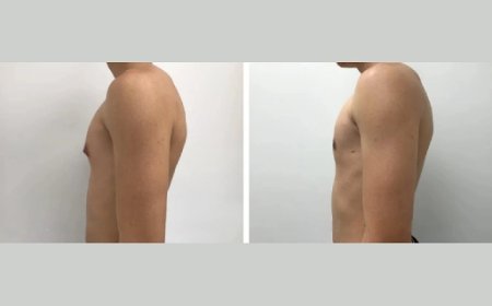 Preparing for Gynecomastia Surgery: What Dubai Patients Should Know