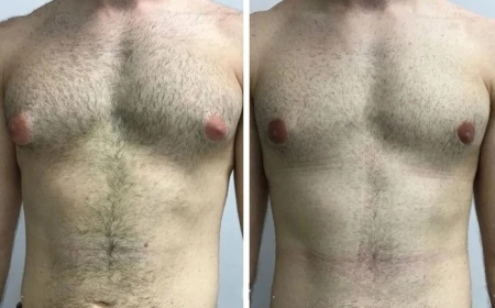 Is Male Breast Reduction Safe? Insights on Gynecomastia in Dubai