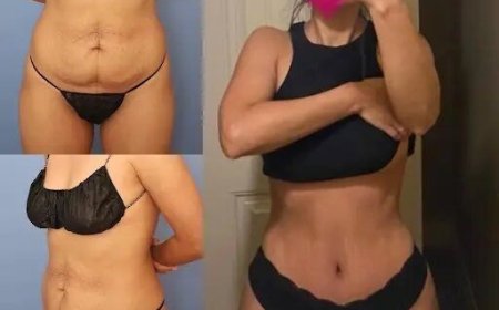 Tummy Tuck in Dubai: A Comprehensive Overview of the Procedure