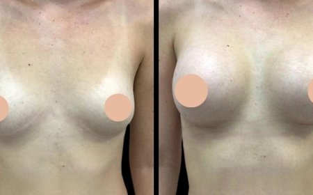 Why Women Are Choosing Breast Augmentation Surgery in Dubai for Body Confidence