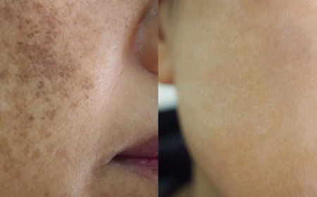 Pigmentation Treatment: Combining Home Care and Professional Treatments for Best Results