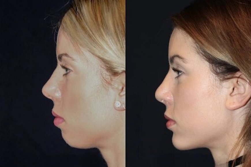 Best Aesthetic Clinic in dubai for Chin Fillers: How to Prepare Your Skin