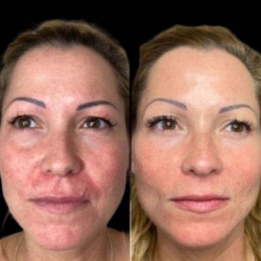 Drive Skin Brilliance with Profhilo in Dubai