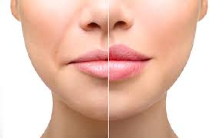 Lip Injections Near Me | GaliDerm Aesthetics in Royal Palm Beach