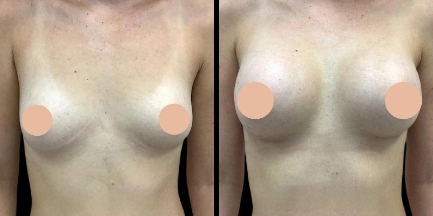 Breast Augmentation in Dubai: Top Benefits of Choosing Dubai for Your Surgery