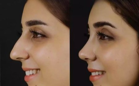 The Best Septoplasty Surgeon in Dubai Shares Post-Surgery Tips