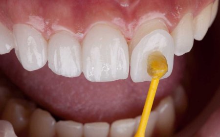 Alles wat u moet weten over tandheelkundige behandelingen: van gaatjes tot wortelkanaalbehandelingen