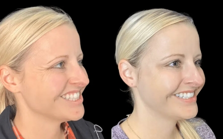 How the Best Plastic Surgeon in dubai Uses Botox to Enhance Facial Symmetry