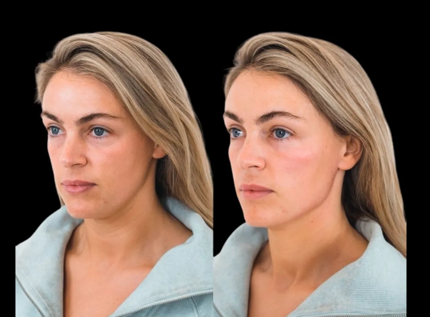 Why Cheek Fillers Treatments in Dubai Are Gaining Popularity