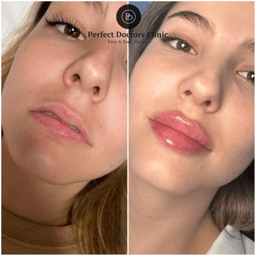 Cheek Filler Before and After Using Juvederm in Dubai